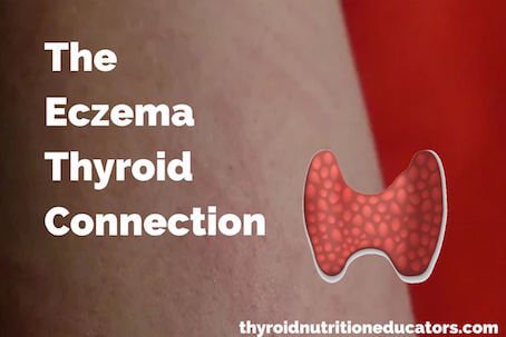 The Eczema Thyroid Connection: Research & Personal Experiences ...